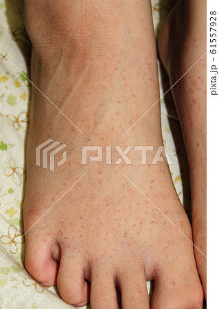 アレルギー疾患 血管性紫斑病の写真素材