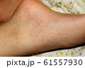 アレルギー疾患　血管性紫斑病 61557930