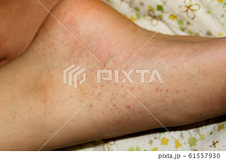アレルギー疾患　血管性紫斑病 61557930