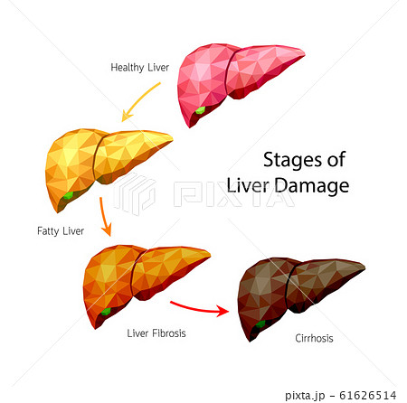 Stages of liver damage, polygonal art style. Stages of liver damage, polygonal art style. 61626514