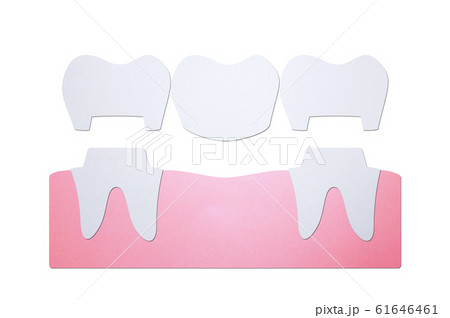 dental crown with bridge, installation process and change of teeth dental crown with bridge, installation process and change of teeth 61646461