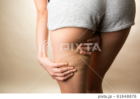 太もものセルライト / 若い女性 太もものセルライト / 若い女性 61648876