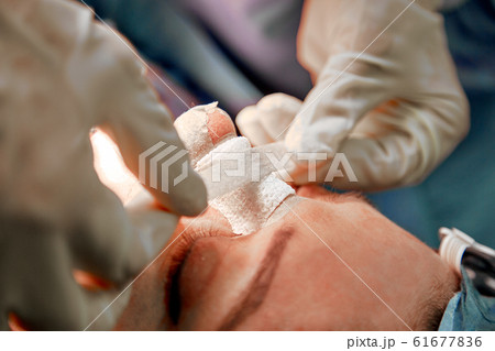 A surgeon with gloves is operating on his nose. Rhinoplasty, close-up operation. Blue light, teamwork, health, beauty. A surgeon with gloves is operating on his nose. Rhinoplasty, close-up operation. Blue light, teamwork, health, beauty. 61677836