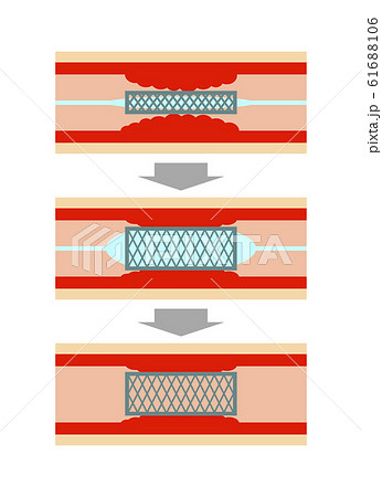 血管のステント治療 61688106