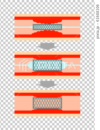 血管のステント治療 61688106