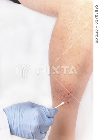nurse's hands healing a painful eczema on a nurse's hands healing a painful eczema on a 61705895