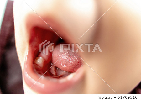 Close up of baby new tooth. Teething, ache and pain Close up of baby new tooth. Teething, ache and pain 61709516
