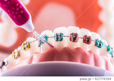 Tooth model from dental braces with inter dental Tooth model from dental braces with inter dental 61774594