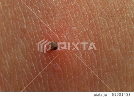 Small Tick on human skin sucking blood Small Tick on human skin sucking blood 61901453