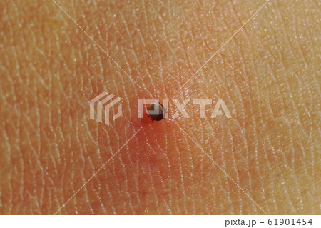 Small Tick on human skin sucking blood Small Tick on human skin sucking blood 61901454