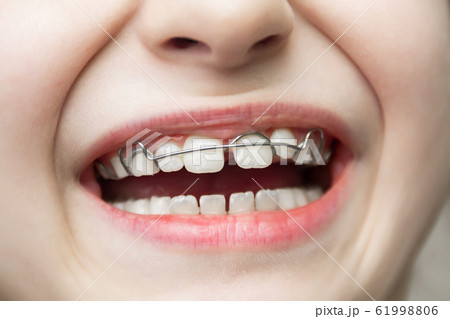 A girl with a removable orthodontic appliance. A 61998806