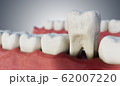 Infected tooth in mouth. 3D rendered illustration. 62007220