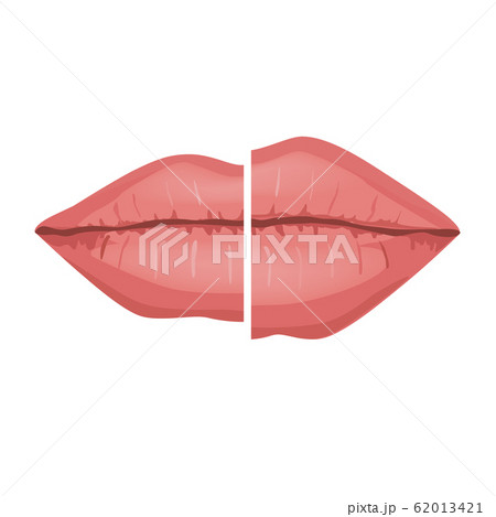 Female Lips Before and after Filler Injections, Vector Infographic illustration. Beautiful and Sexy Perfect Lips Isolated on White background 62013421