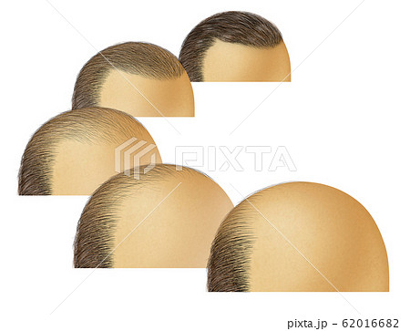 Hairloss or Hair loss 62016682