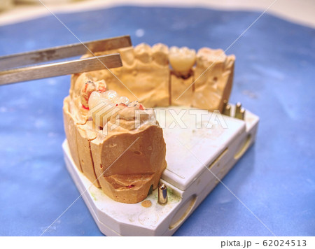 Plaster cast of human jaws. Dental casting gypsum 62024513