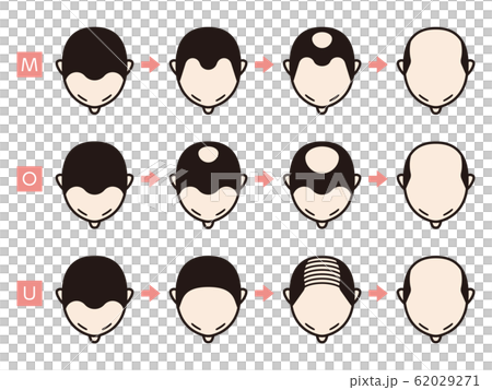 ハミルトン・ノーウッド分類　ハゲ 62029271