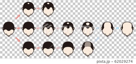 Hamilton Norwood Classification Bald 62029274