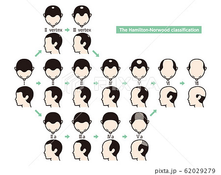 ハミルトン ノーウッド分類 ハゲのイラスト素材