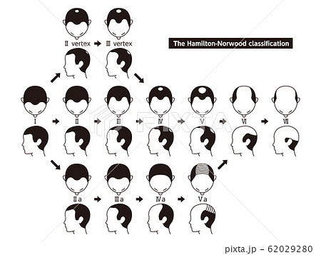 ハミルトン・ノーウッド分類　ハゲ 62029280