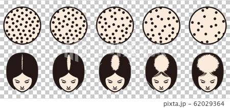 Ludwig's Classification Bald 62029364