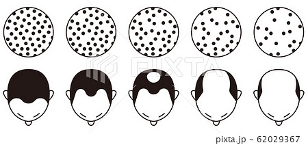 ハミルトン・ノーウッド分類　ハゲ 62029367