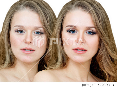 Woman with acne before and after treatment and makeup. Woman with acne before and after treatment and makeup. 62039313