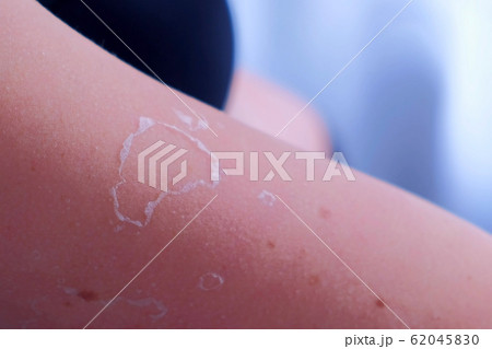 Woman with peeling skin from UV sunburn on legs and tummy, closeup. 62045830