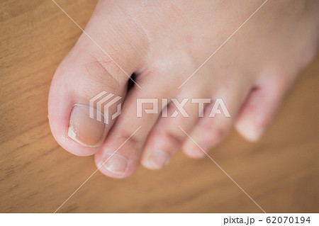 woman toe with broken nail; woman suffering from 62070194