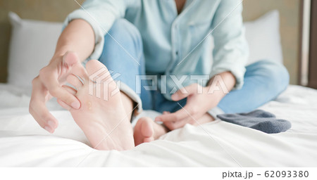 applying cream for athletes foot 62093380