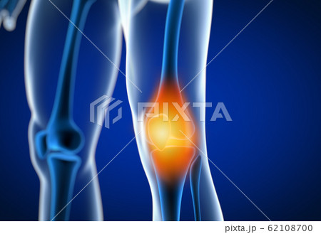 3d rendered illustration of a painful knee 3d rendered illustration of a painful knee 62108700