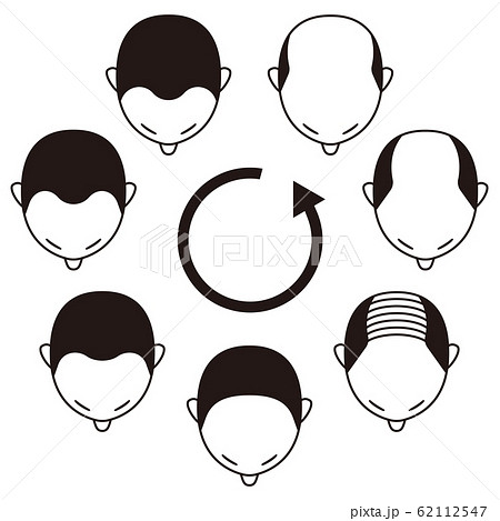 薄毛の進行　男性　ハゲ 62112547