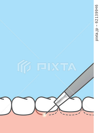 Blank banner Gingivoplasty & Gingivectomy 62139946