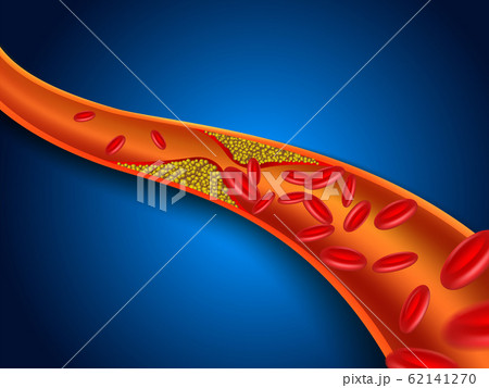 Cholesterol is clogged in the blood vessels. Vector EPS file. 62141270
