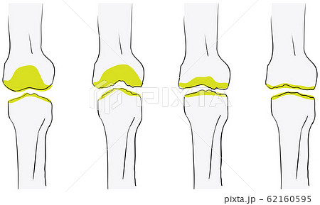 変形性膝関節症が悪化する流れのベクターイラストのイラスト素材