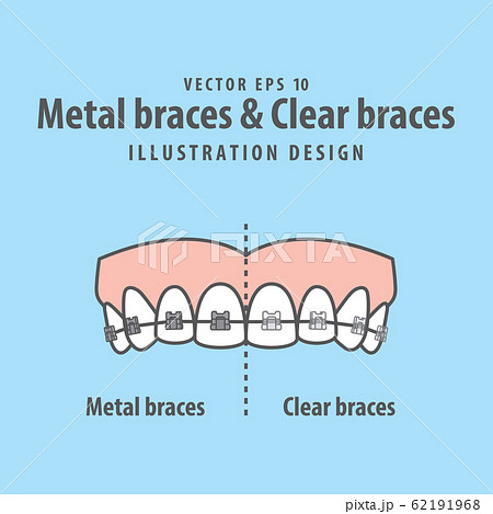 Metal braces teeth & Clear braces teeth (Upper) 62191968