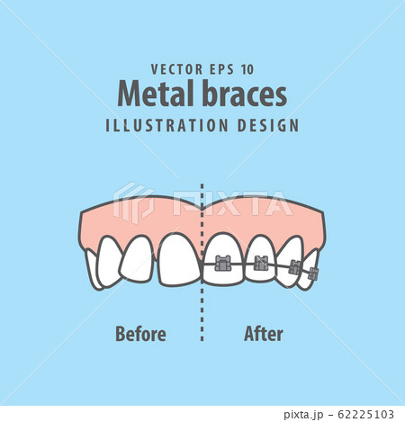 Compare upper teeth Metal braces before and after 62225103