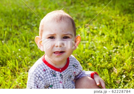 Chicken pox concept. Toddler boy with chicken pox rash on a walk Chicken pox concept. Toddler boy with chicken pox rash on a walk 62228784