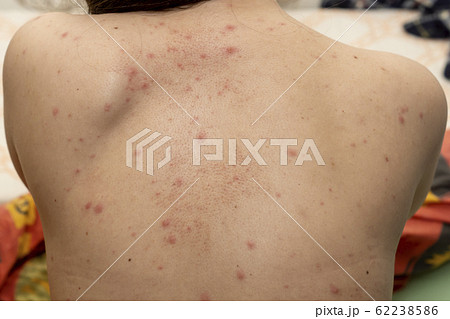 Upper back of young woman contracted chickenpox and red rash spilled on her skin 62238586