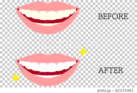 Aesthetic dentistry, illustration of yellowed teeth and white teeth 62253461