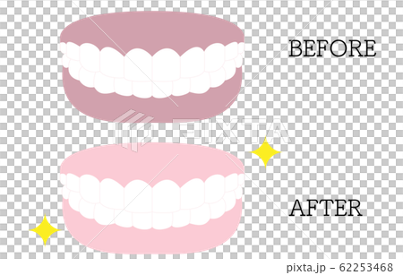 審美歯科 白い歯とピンクの歯茎 白い歯と黒ずんだ歯茎のイラストのイラスト素材