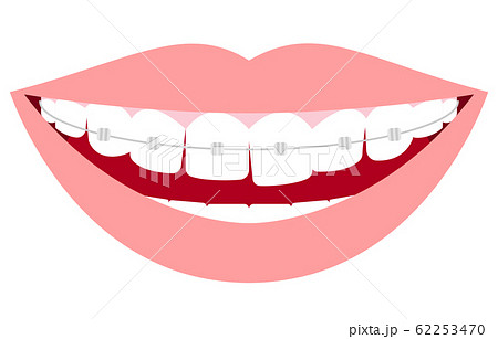 審美歯科 歯列矯正のイラスト 歪んだ歯並びとメタルブラケットのイラスト素材