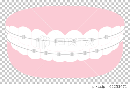 Illustration of esthetic dentistry and orthodontics: beautiful teeth arrangement and metal bracket 62253471