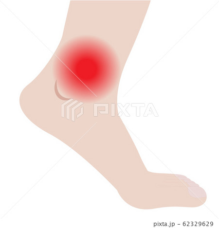 Swelling of the feet and ankles from infected or injury 62329629