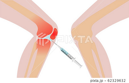 Knee injection inflammation redness recovery 62329632