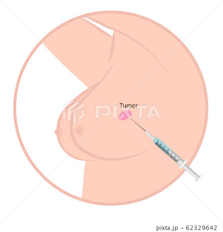 Breast cancer tumor 62329642