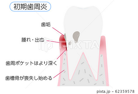 歯周病の進行段階別イラスト 初期歯周炎のイラスト素材