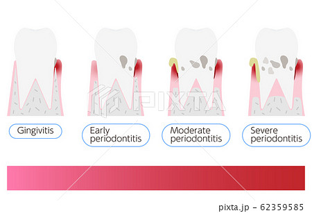 歯周病の進行段階別イラスト 進行順のイラスト素材