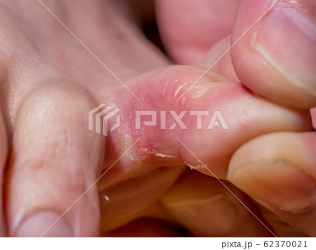 初期症状の水虫 62370021