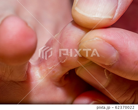 初期症状の水虫 62370022