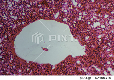 肺切片 顕微鏡写真 肺切片 顕微鏡写真 62400310